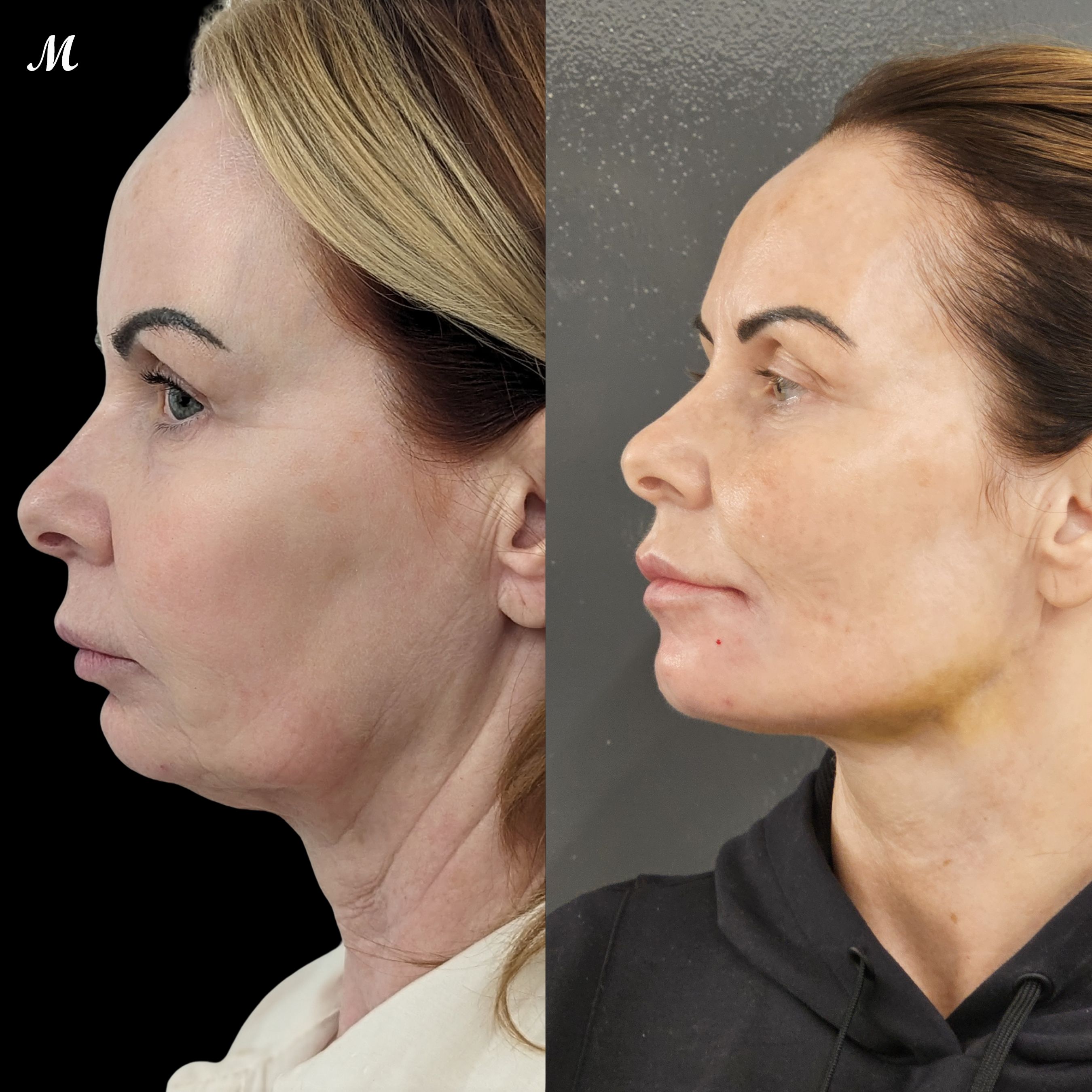 Neck Thread Lift